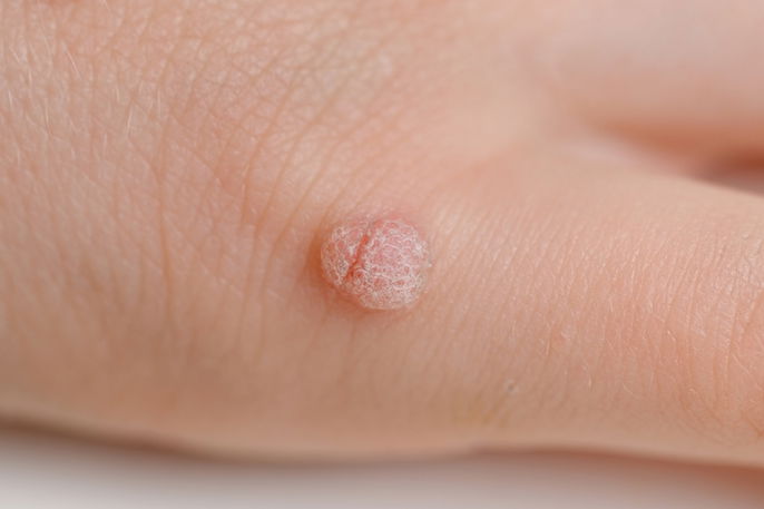 Foto de verruga de VPH en la mano