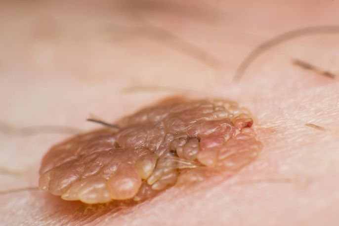 Foto de verruga genital
