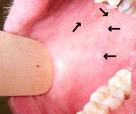Illustrative image of the article Measles Symptoms: 8 Signs & Symptoms (w/ Online Quiz)