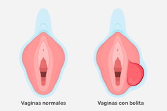 Imagen ilustrativa del artículo Bolitas en los labios mayores: 11 causas y qué hacer (con fotos)