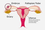 Illustrative image of the article Ectopic Pregnancy: Symptoms, Diagnosis, Causes & Treatment